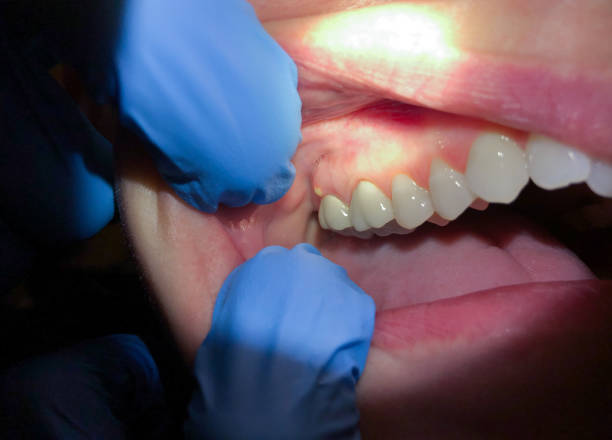Best Emergency Tooth Extraction in Newburyport, MA